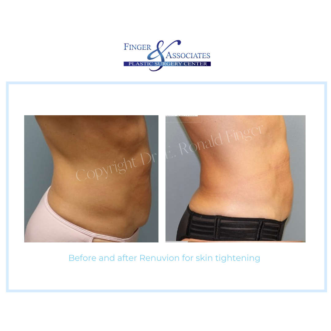 abs of woman before and after skin tightening with Renuvion
