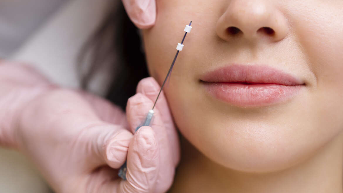 PDO thread Lift at New Youth medical Spa