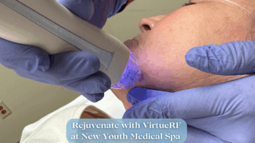 Virtue RF at New Youth Medical Spa Savannah, GA