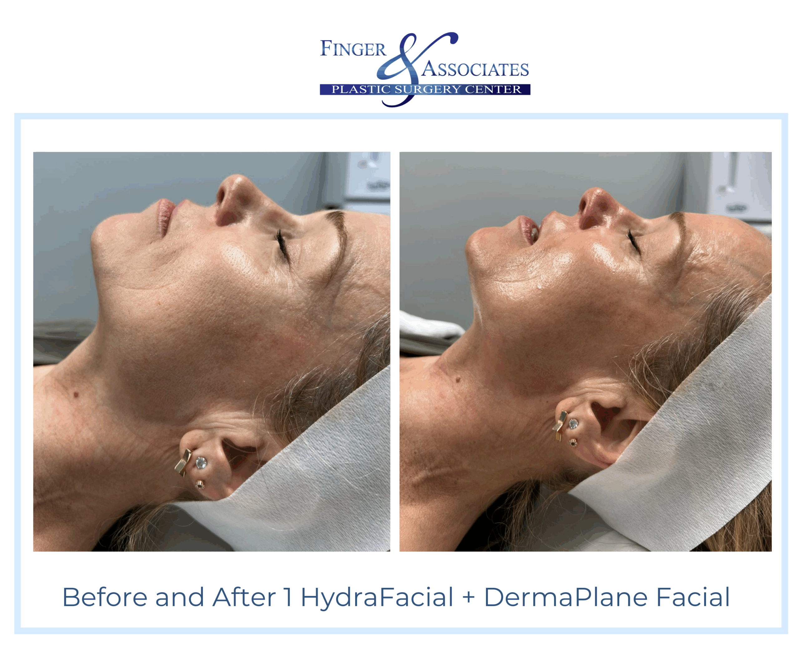 Before and After HydraFacial and DermaPlane by Holly at Finger and Associates