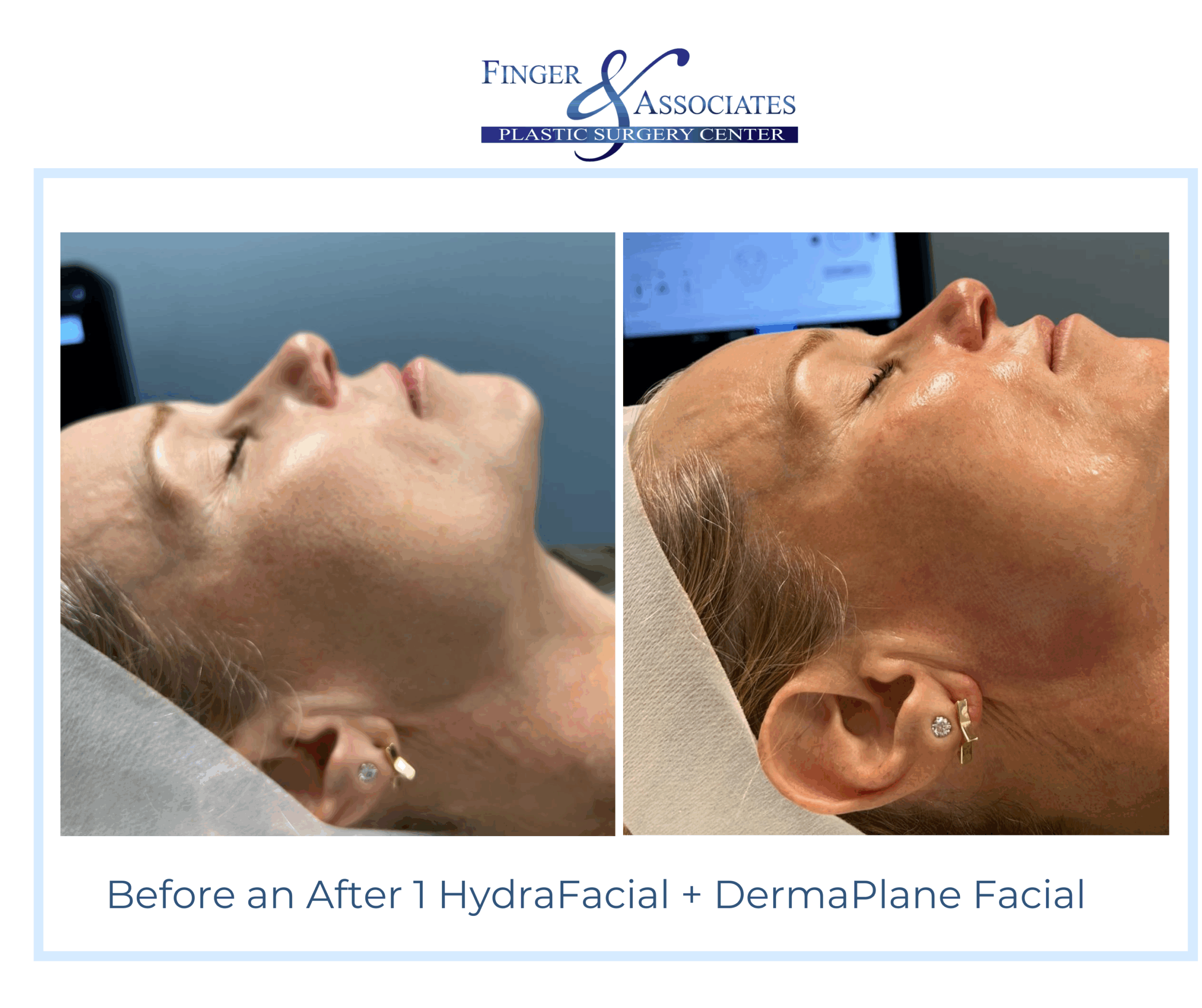 Before and After HydraFacial and DermaPlane by Holly at Finger and Associates