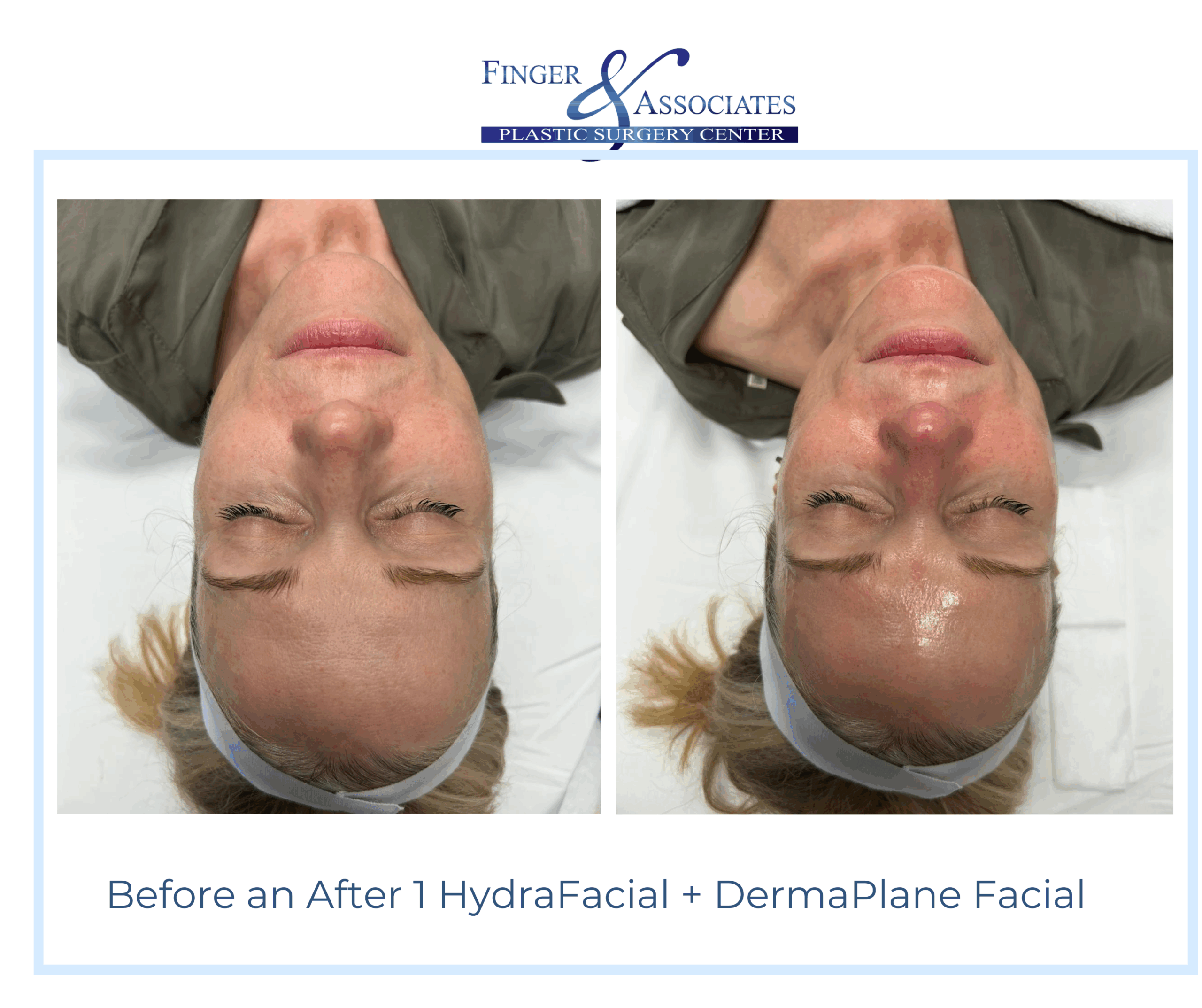 Before and After HydraFacial and DermaPlane by Holly at Finger and Associates