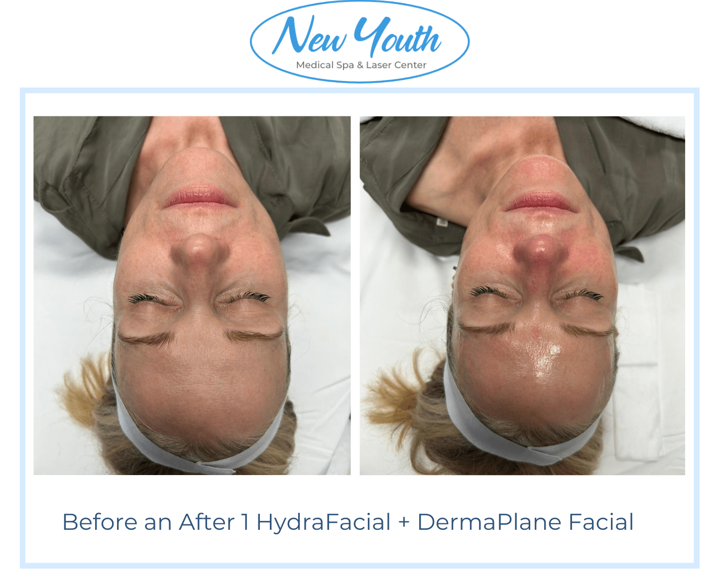 Before and After HydraFacial and DermaPlane by Holly at New Youth Medical Spa