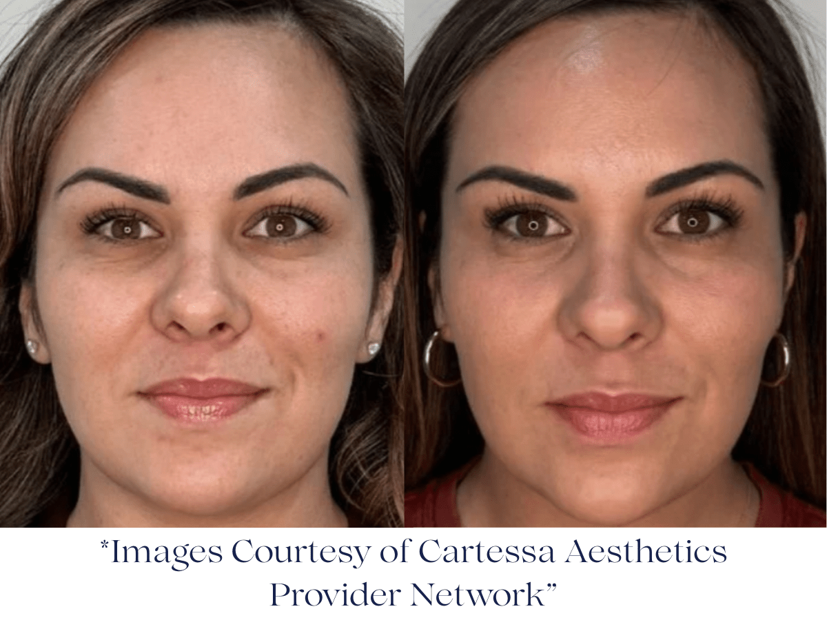 Before and after one Session of Everesse RF