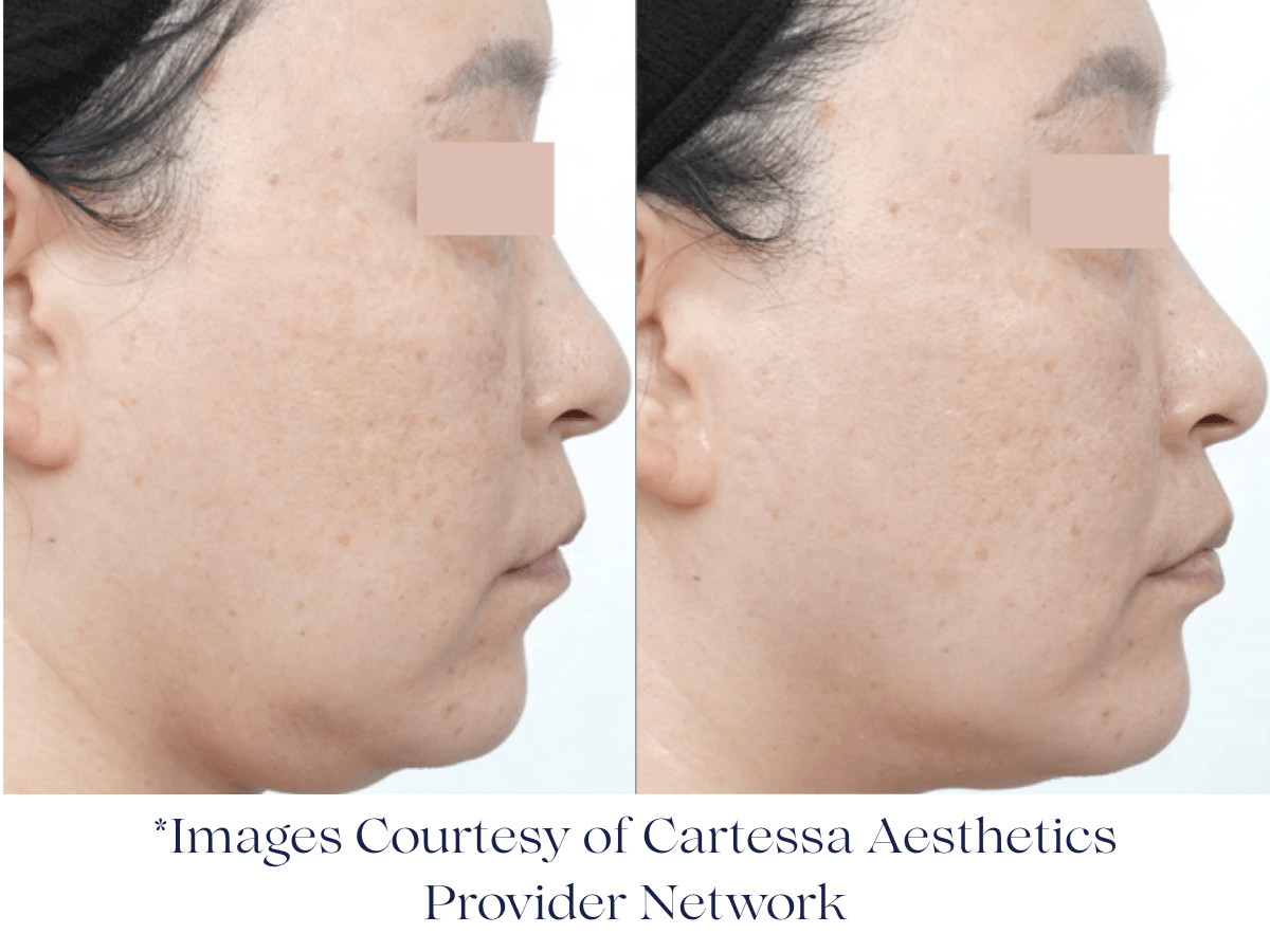 Before and immediately after Everesse RF