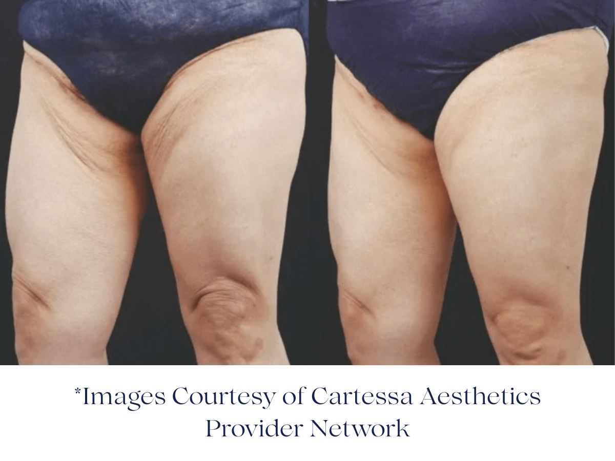 Before and after two Session of Everesse RF