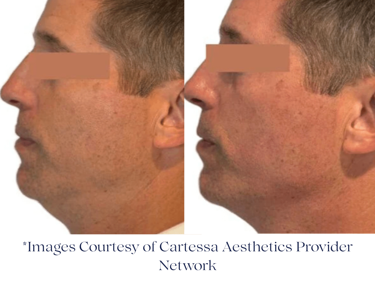 Before and immediately after Everesse RF