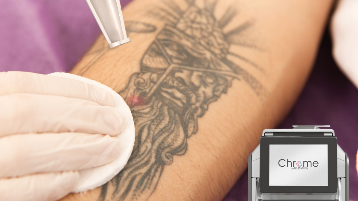 Chrome Lase Station for Tattoo removal at New Youth Medical Spa in Savannah, GA