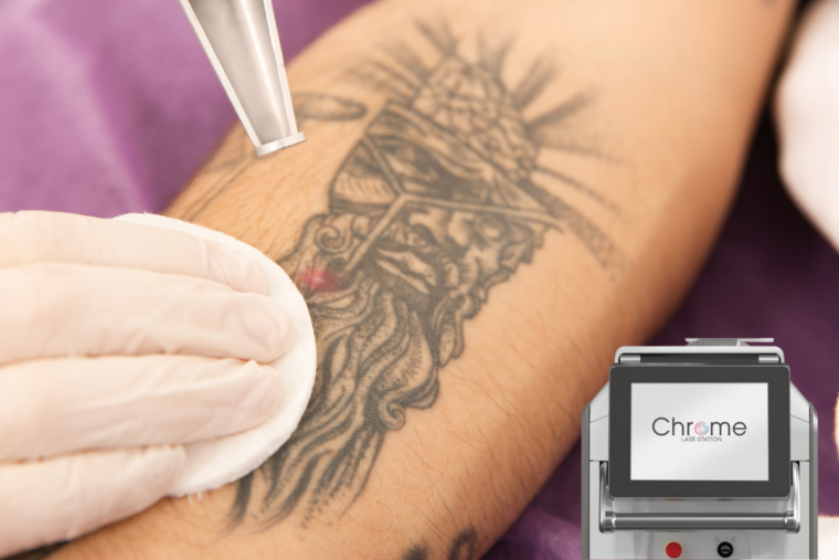 Chrome Lase Station for Tattoo removal at New Youth Medical Spa in Savannah, GA